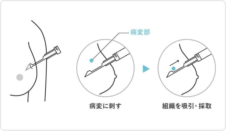 吸引式乳腺組織生検